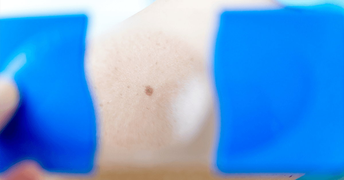Close-up of a small mole on skin, with blue-gloved hands positioned on either side as if examining or preparing for a procedure.